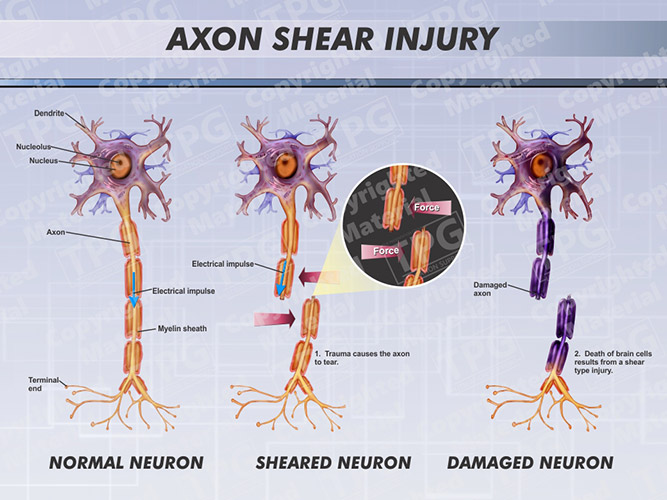Axon Shear Injury The Presentation Group Litigation Support