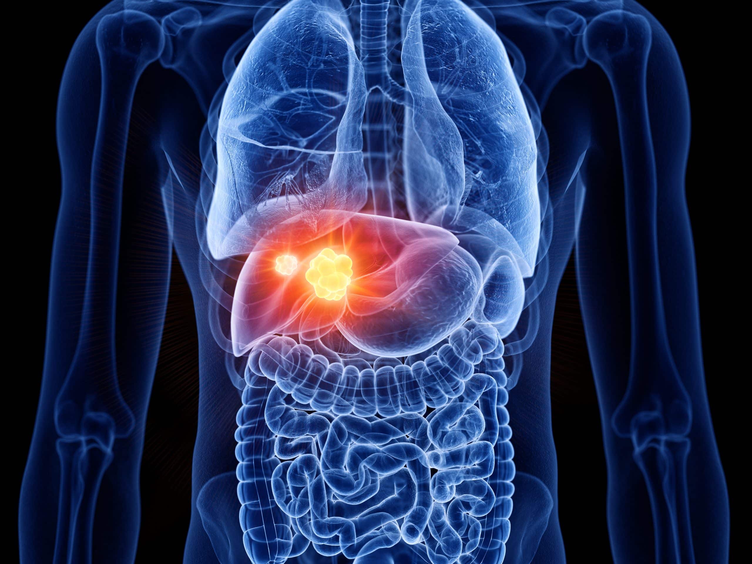 Le cancer du foie, tout ce que vous devez savoir
