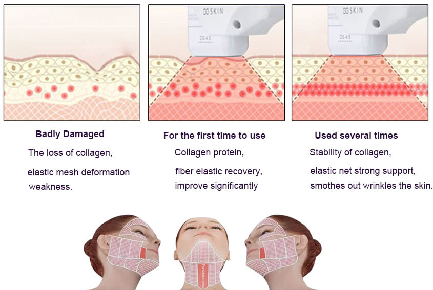 Hifu Facial Lifting Treatment For Face PrettyLasers