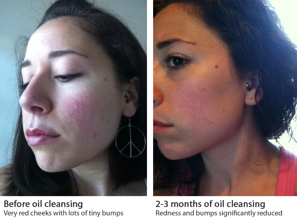 Bye Bye Rosacea, Glowing Skin for the Bride to be Primal