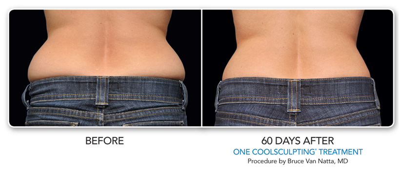 Non Surgical Fat Reduction CoolSculpting Princeton, NJ Liposuction