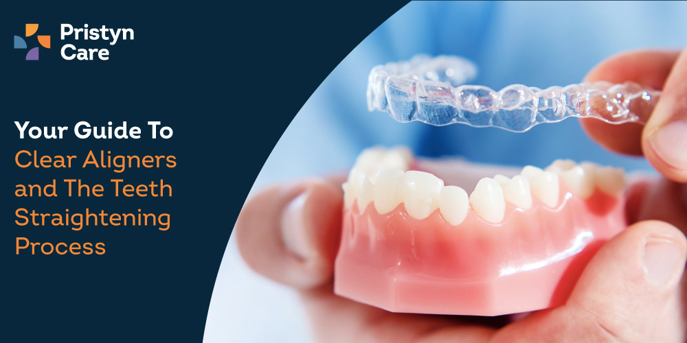 How Clear Aligners Straighten Teeth A StepbyStep Guide