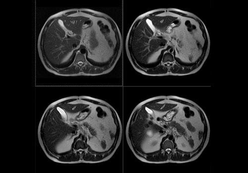 Mri Scan Abdomen - Boven- En Onderbuik Organen - Privatescan