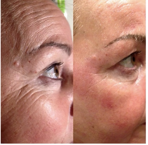 Cryotherapy Facial (Frotox) Treatment