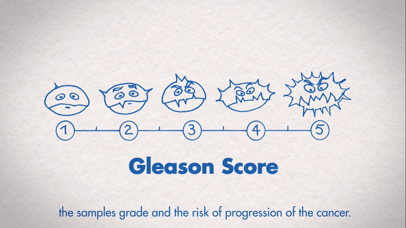 The Gleason score What is it exactly?