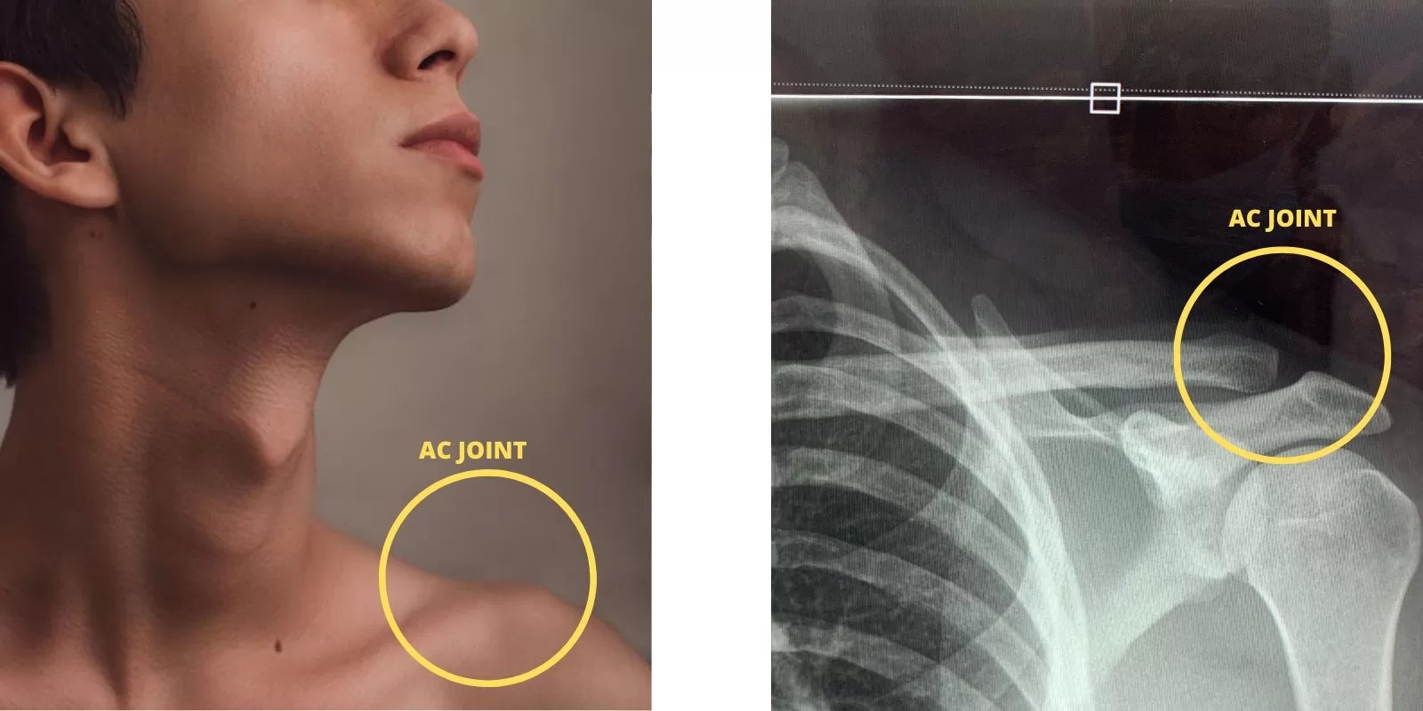 How Do You Diagnose an AC Joint Injury? Pro doctor