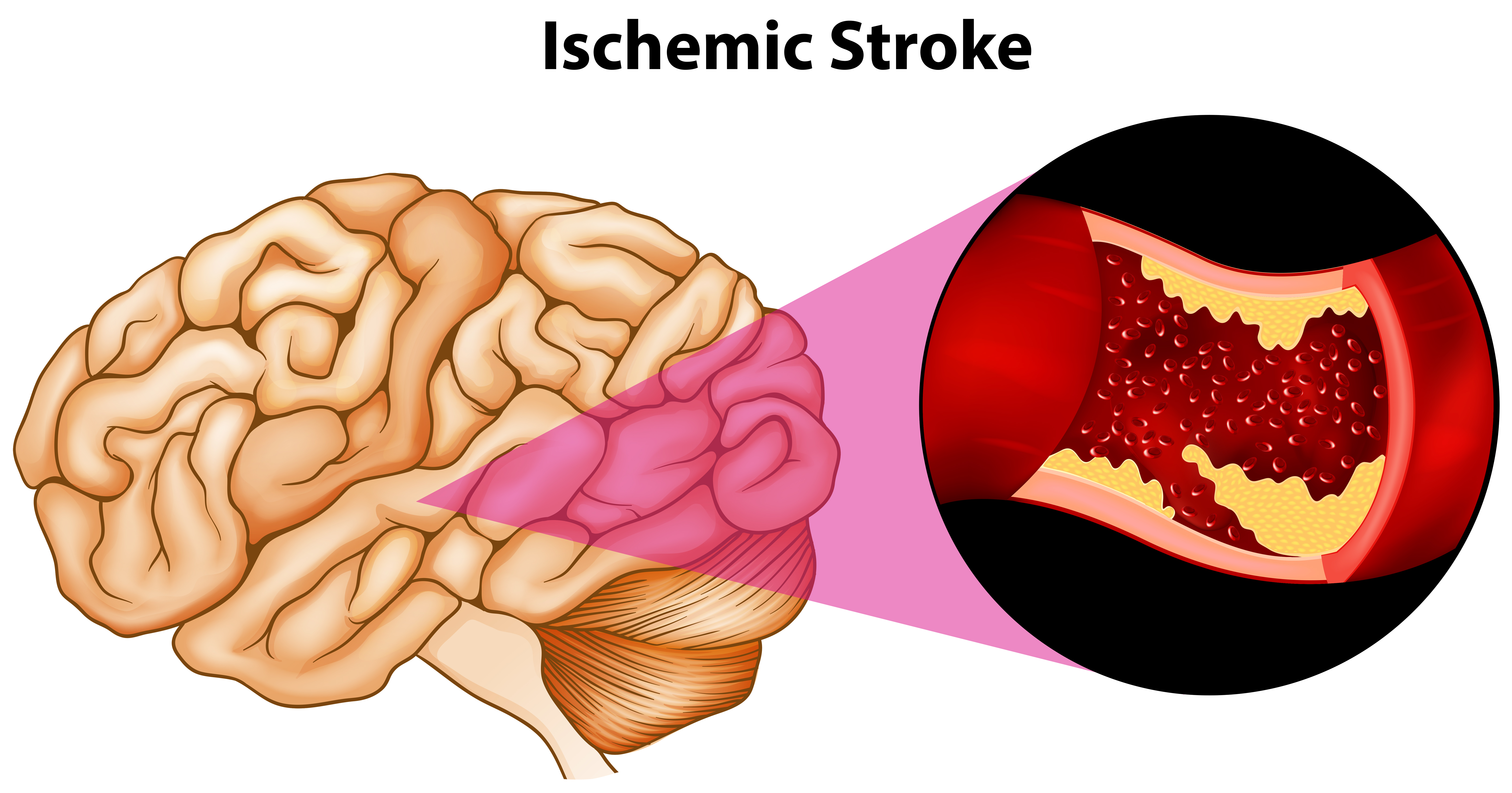 Stroke First Aid Wiki(09)