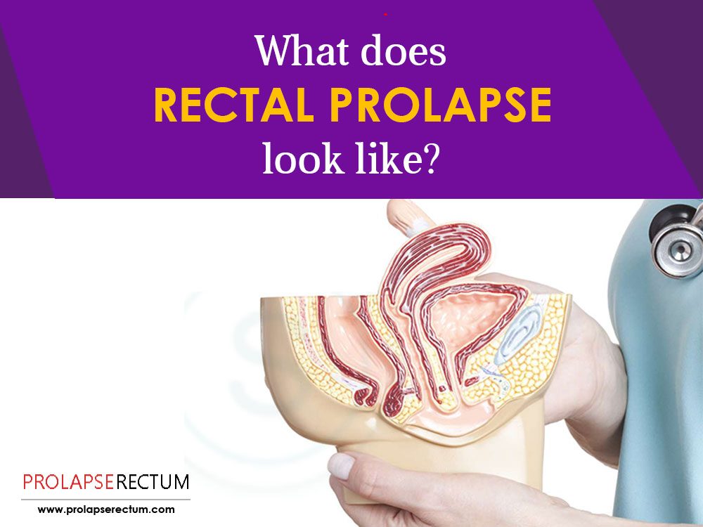 Internal Rectal Prolapse