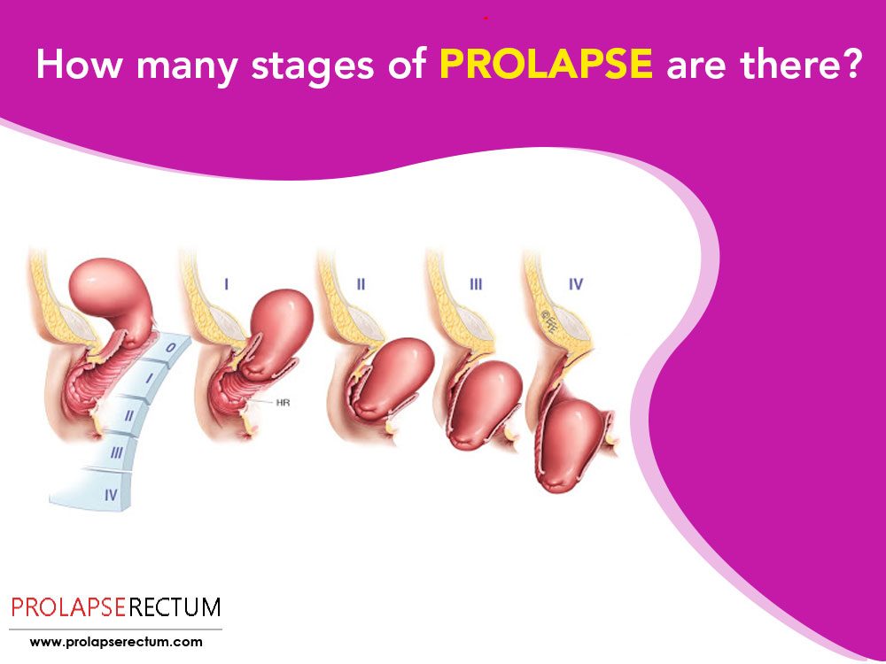 Rectal Prolapse Treatment By Herbal & Ayurvedic Medicines