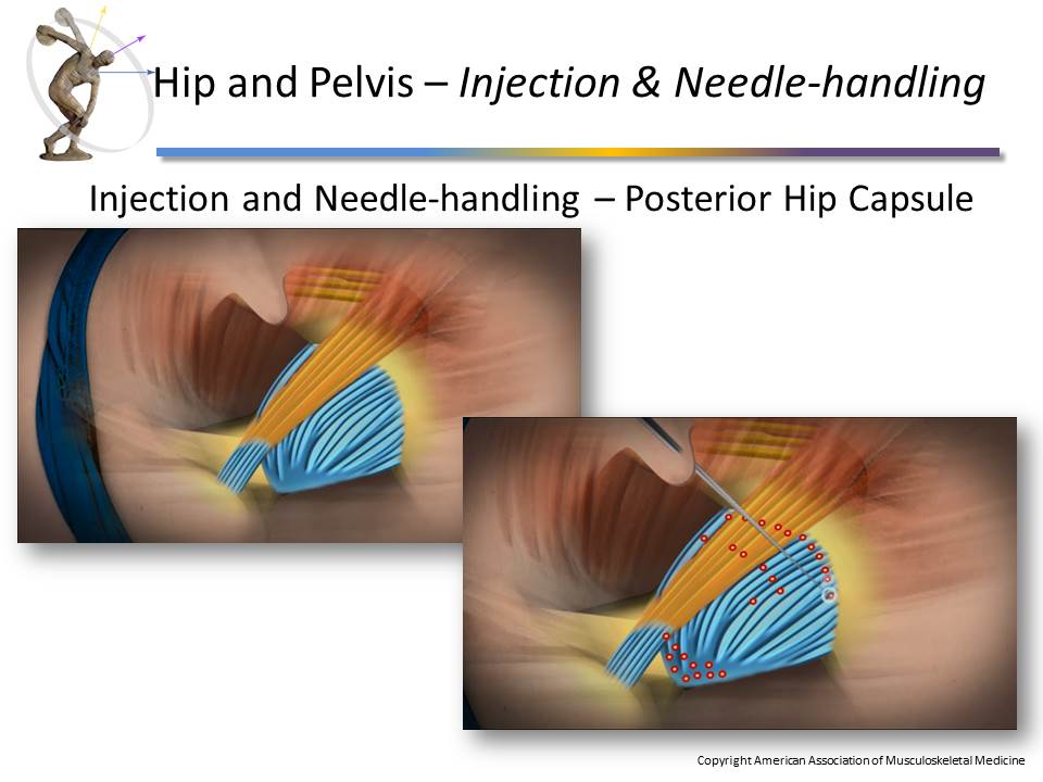 Module 4 Hip and Pelvis Prolotherapy Education