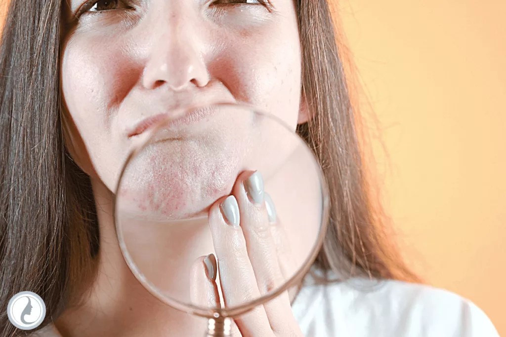 How To Treat Breakouts After Microneedling Pro Needling