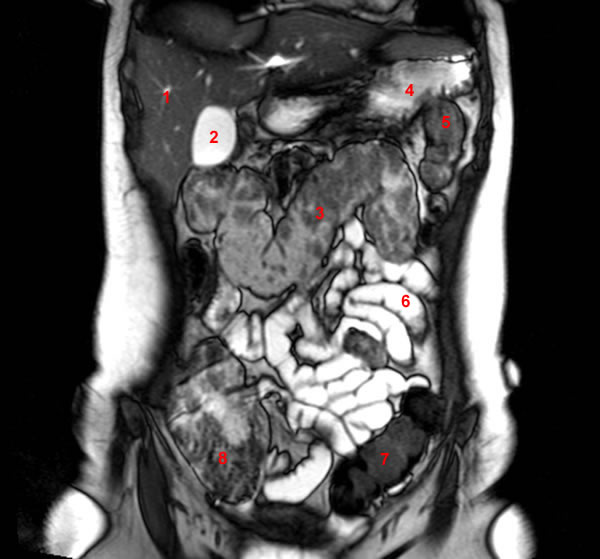 Mri Abdomen Coronal Flashcards by ProProfs