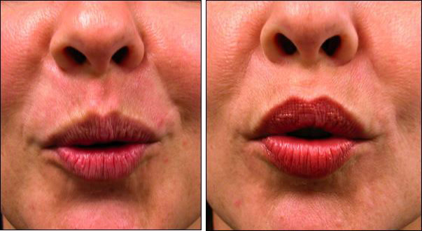 Chicago botox® cosmetic injections before and after pictures