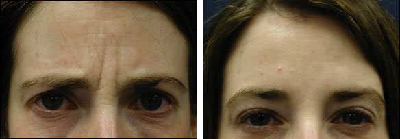 Chicago botox® cosmetic injections before and after pictures