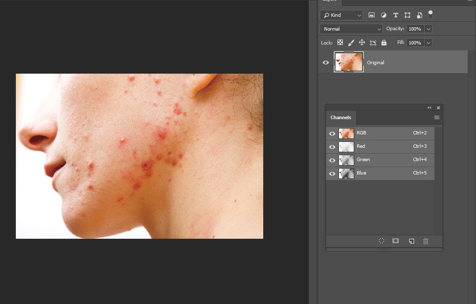 How to Remove Acne in PSD Stack