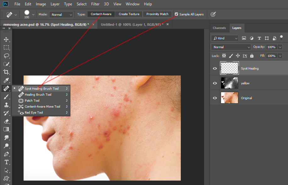 How to Remove Acne in PSD Stack