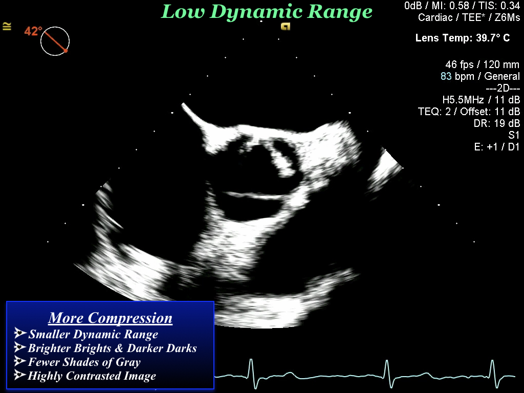 Snell's Law Ultrasound Artifact at Jill Massaro blog