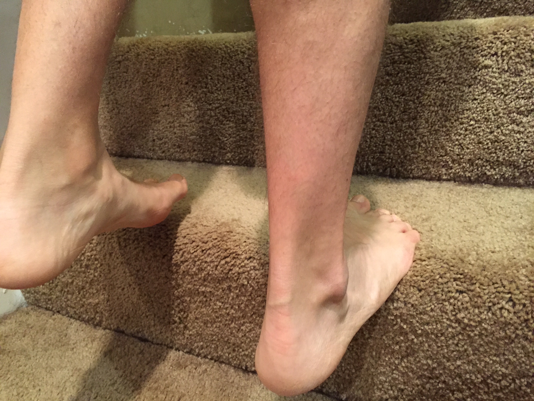 Plantar Fasciitis Treatment How to Heal Heel Pain