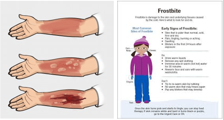 First Aid Management Burns And Frostbite Public Health Notes