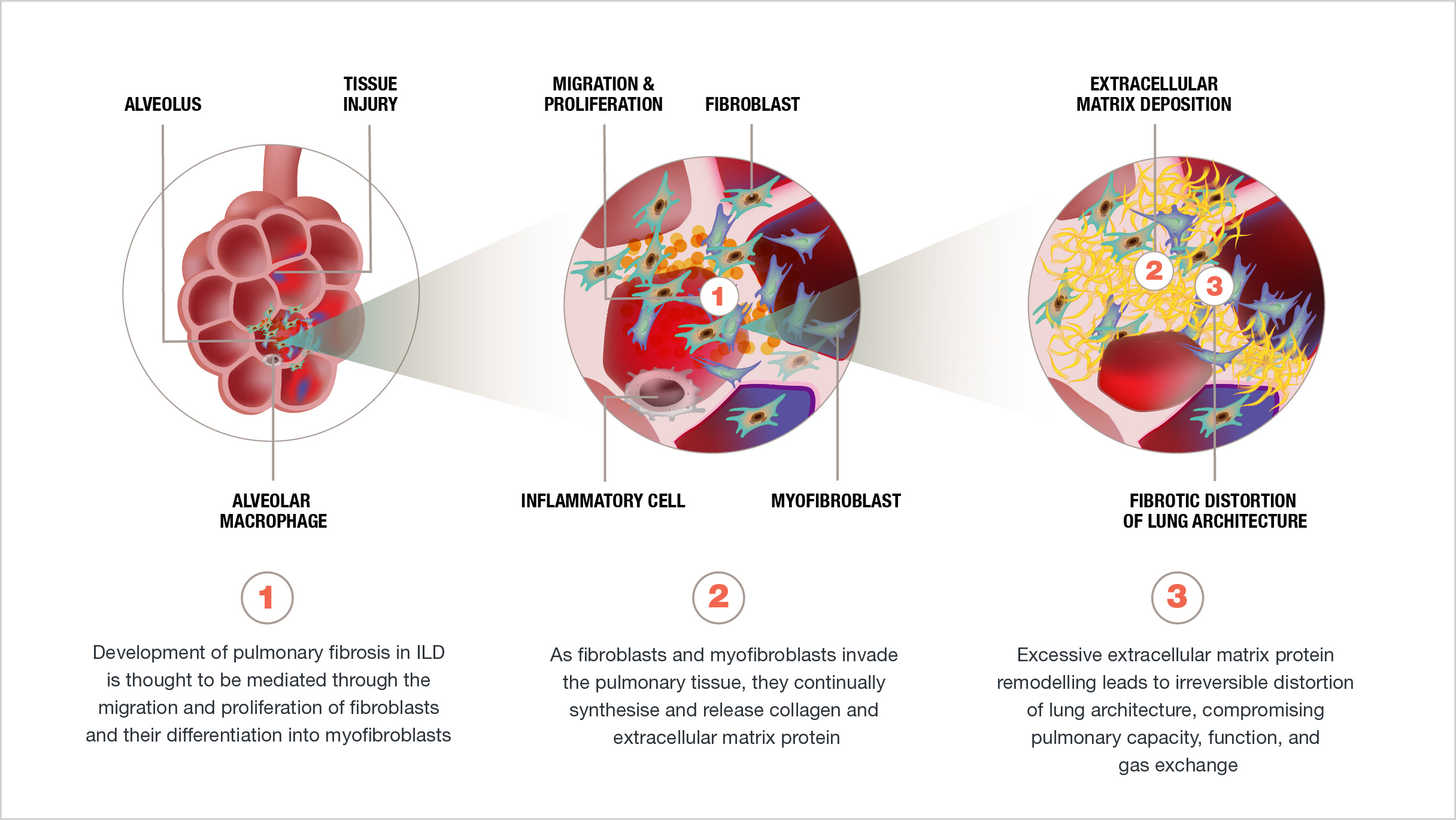 Inflammation and fibrosis in CTDILDs