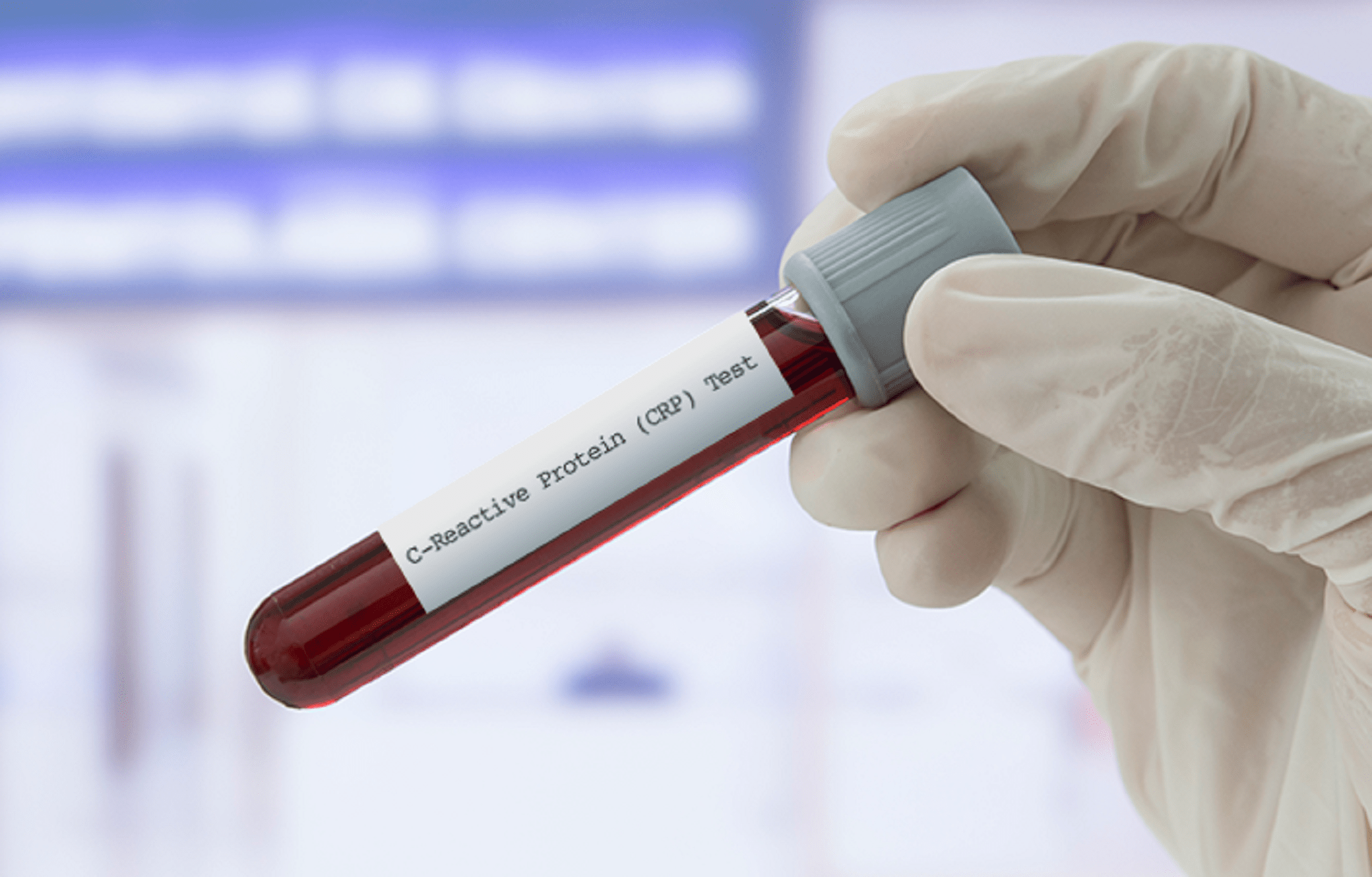 Elevated Level of C Reactive Protein May Predict Risk for Worsening