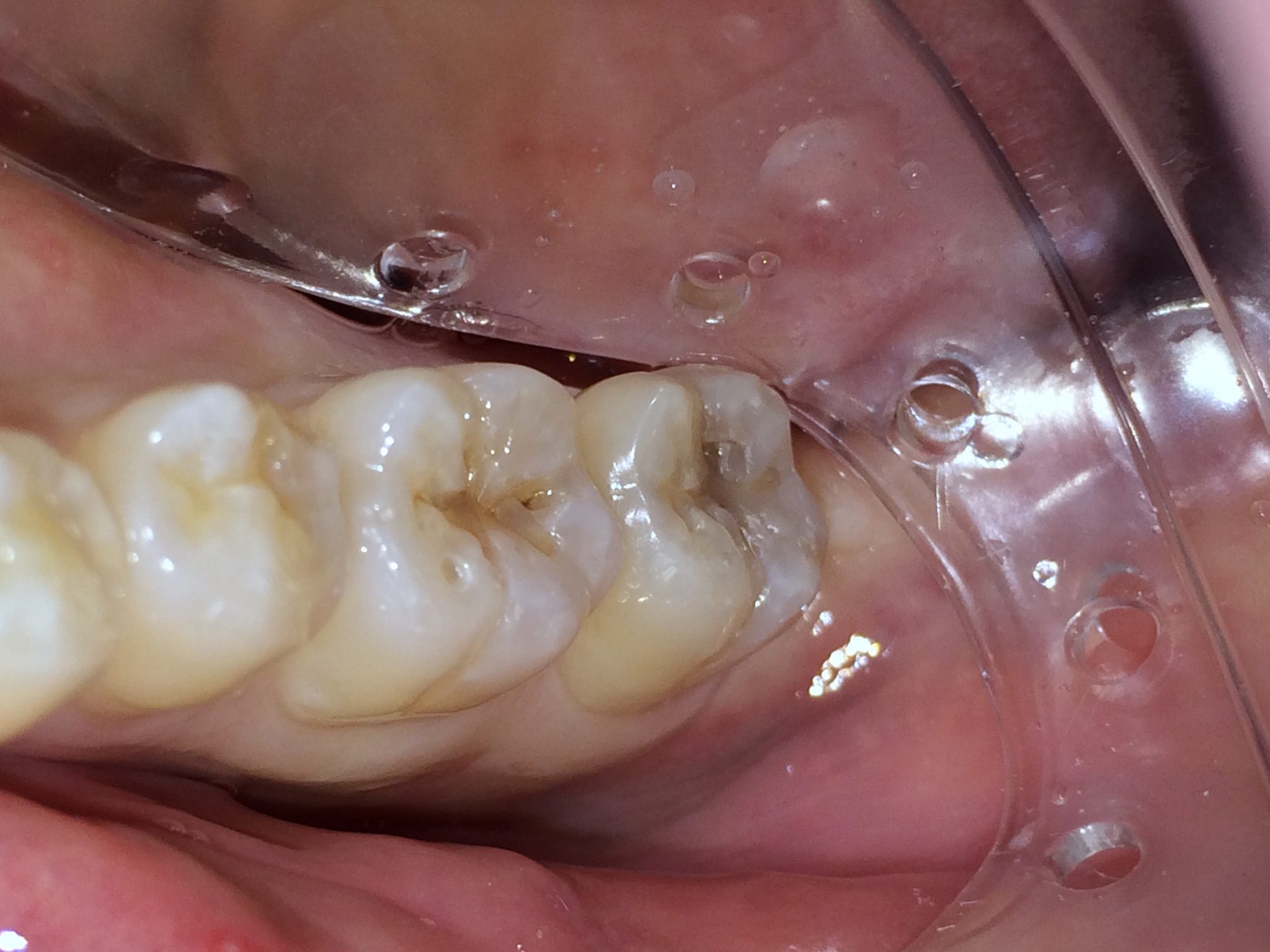 Heroic Dentistry The Open Sandwich Technique Pulpdent