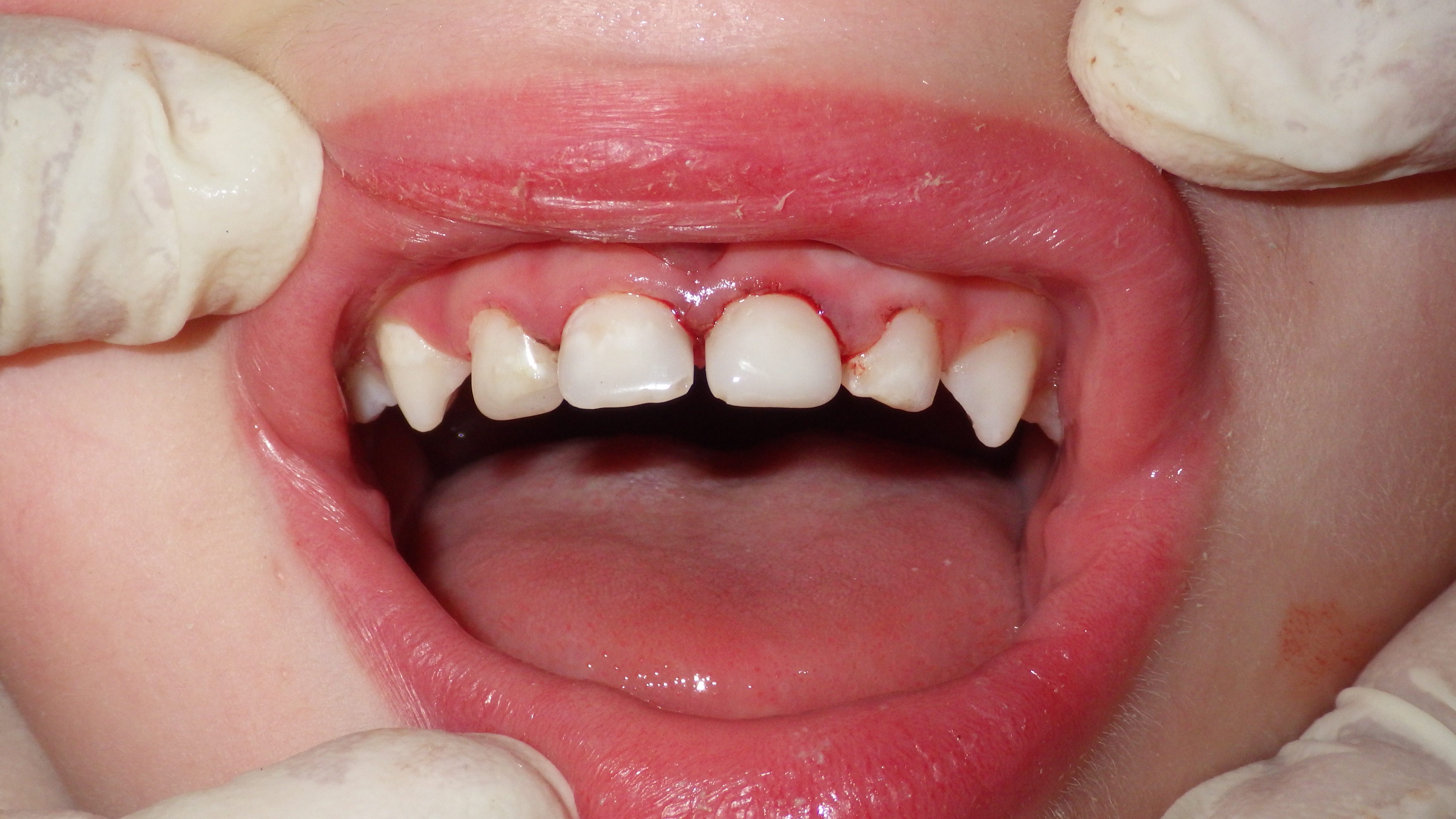 Direct From The Operatory Strip Crowns and ACTIVA KIDS PULPDENT