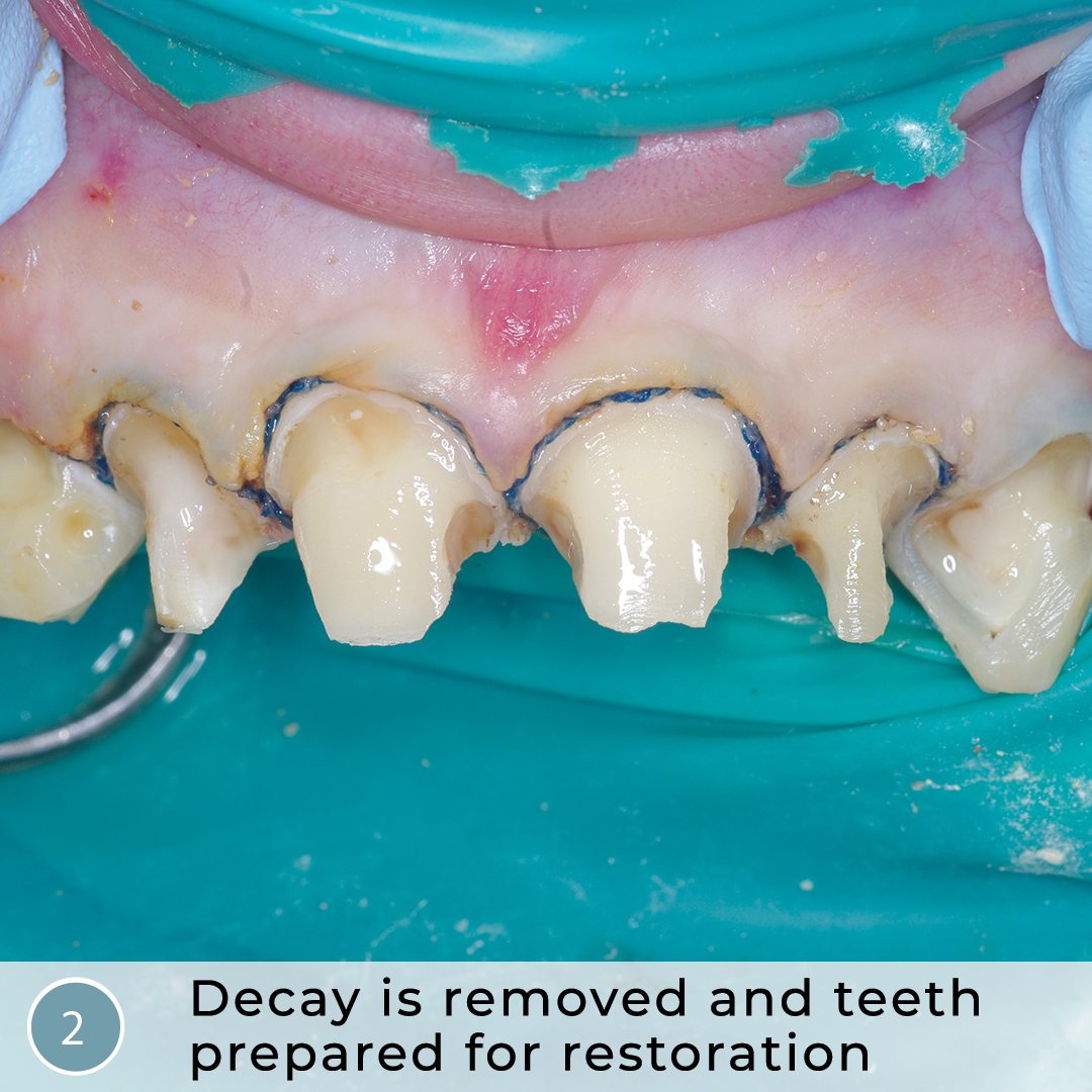 Heroic Dentistry Severe Autism, Rampant Caries, Strip Crowns and