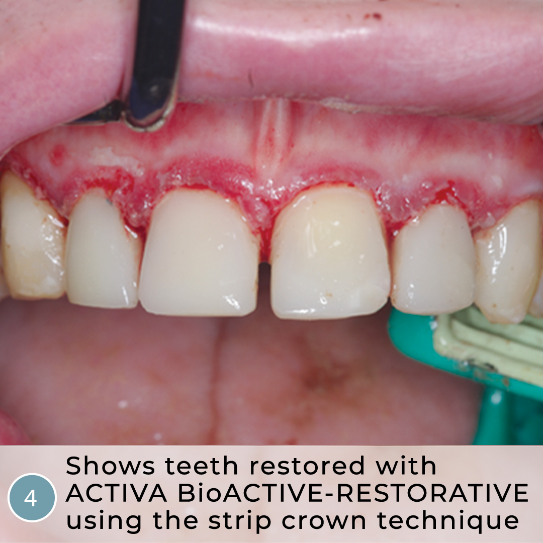 Heroic Dentistry Severe Autism, Rampant Caries, Strip Crowns and