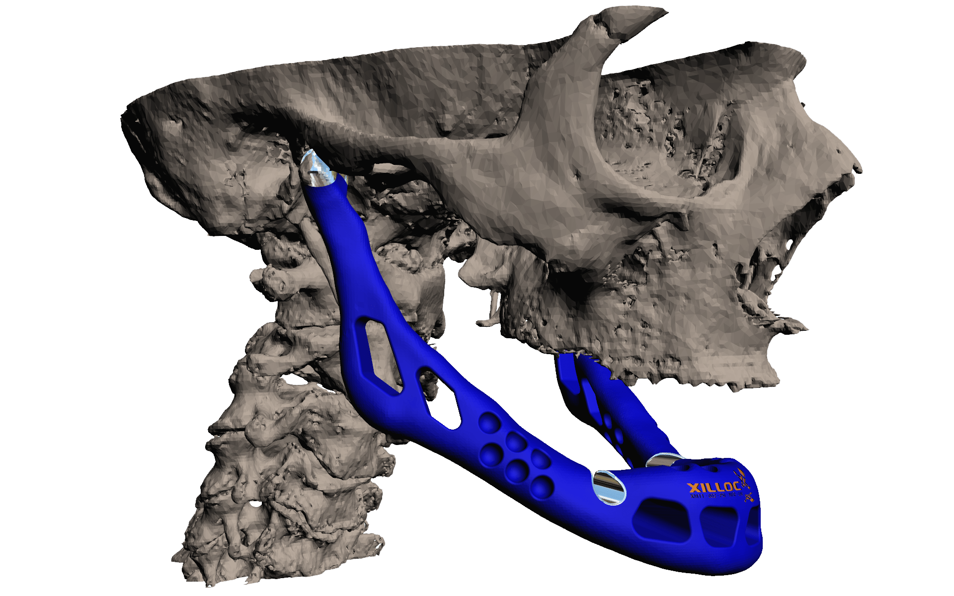 LayerWise builds the world’s first patientspecific lower jaw from CAD