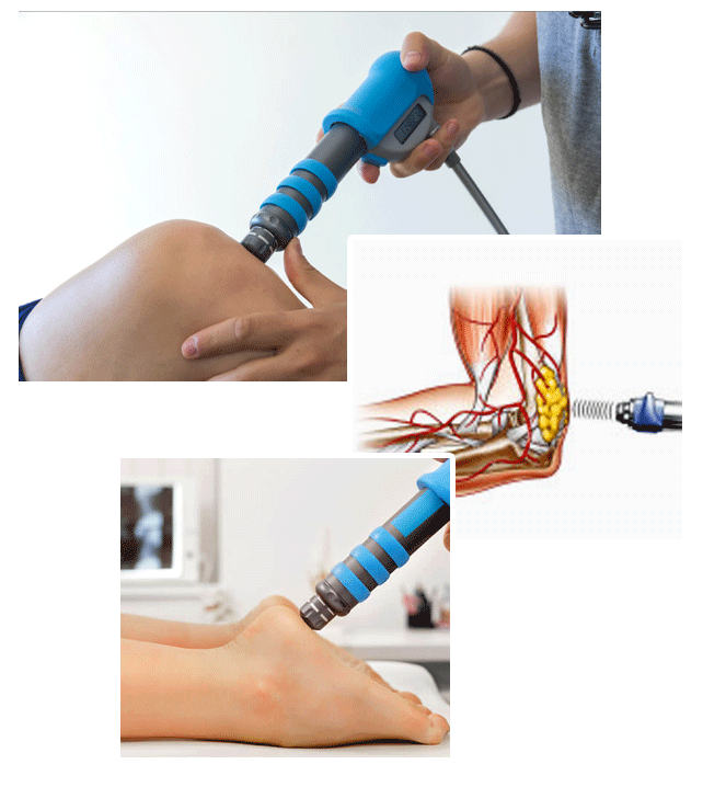 Shockwave Therapy London, Ontario