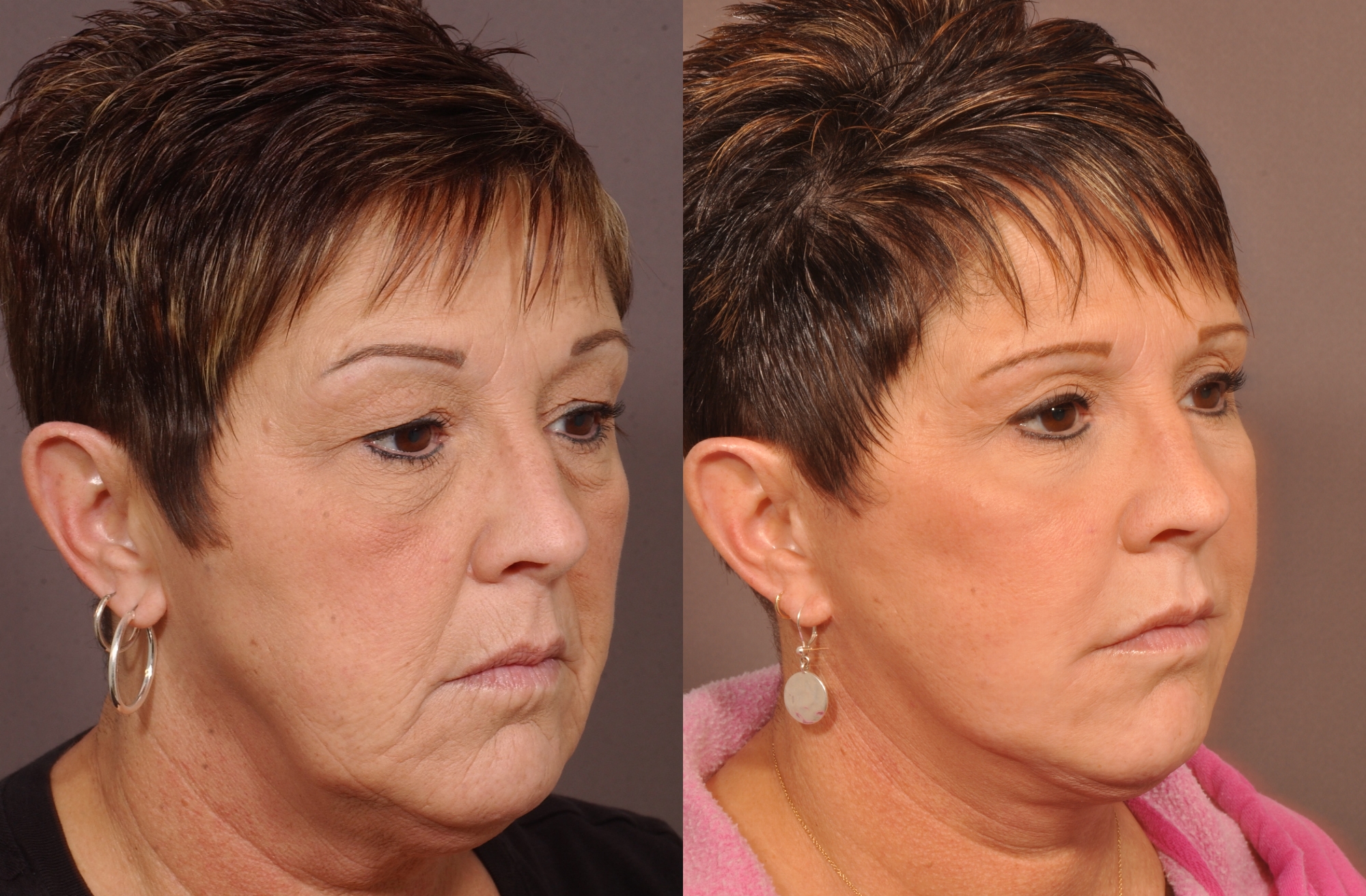 Injectable Treatments vs. Traditional Facelift Surgery Which option is