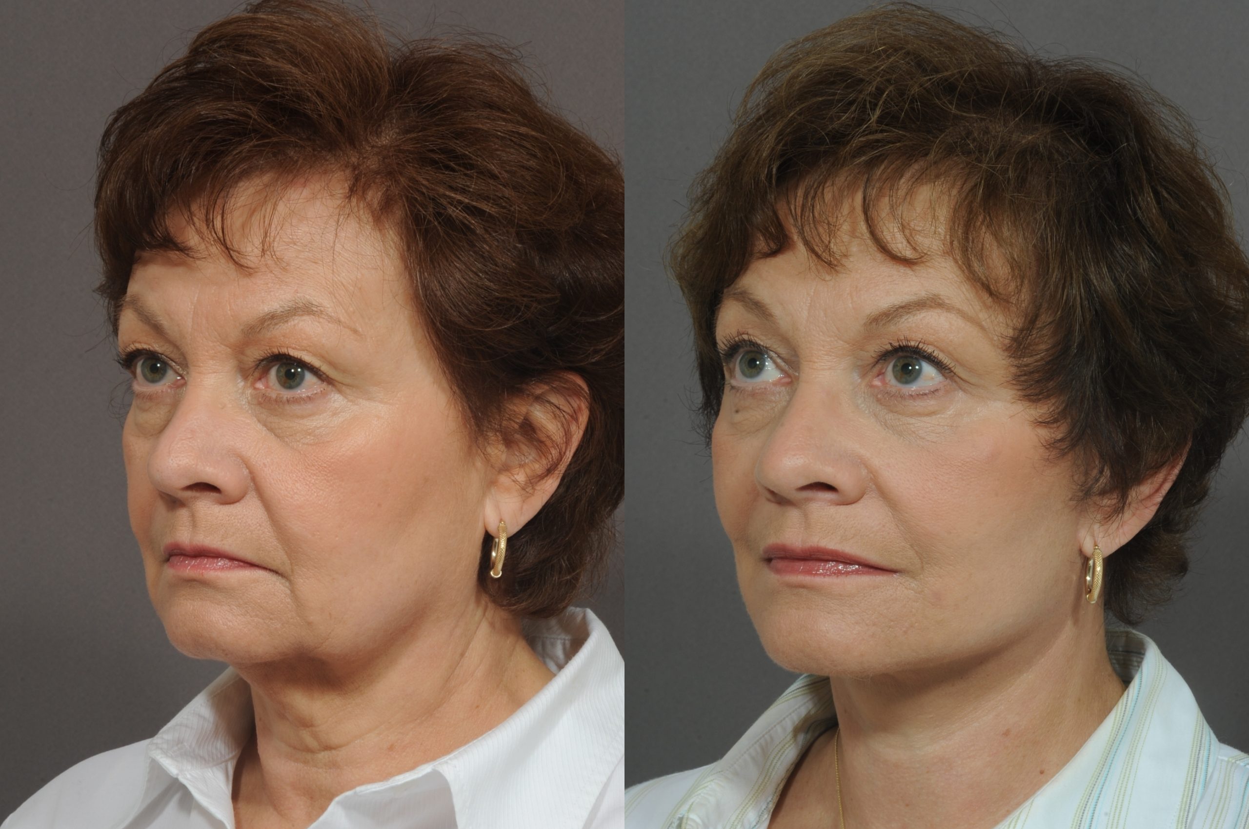 Injectable Treatments vs. Traditional Facelift Surgery Which option is
