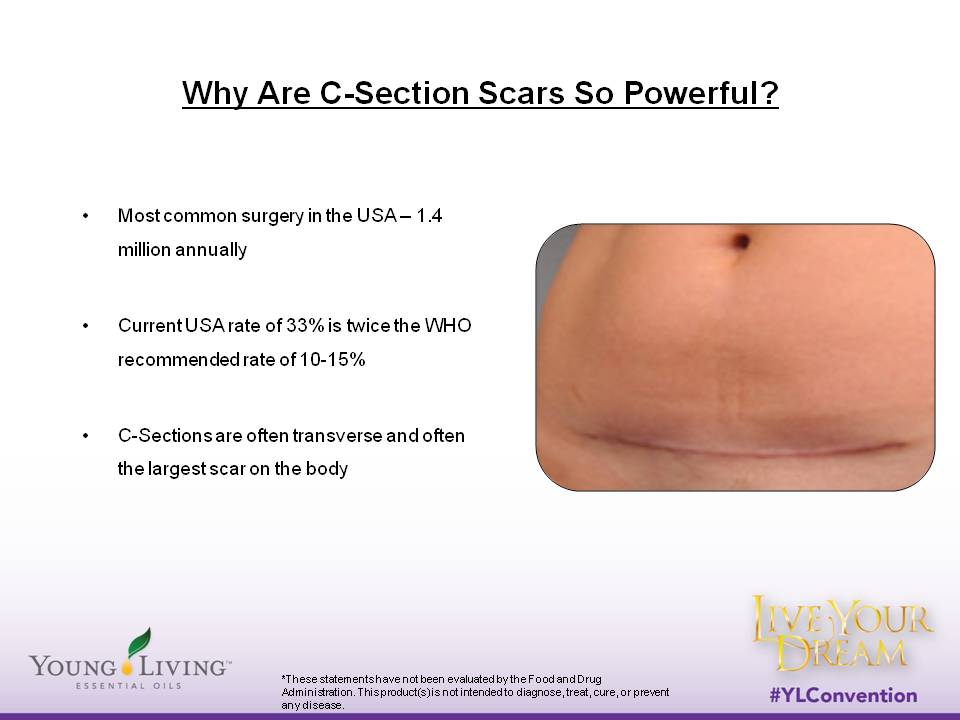 Why Are CSection Scars So Powerful?