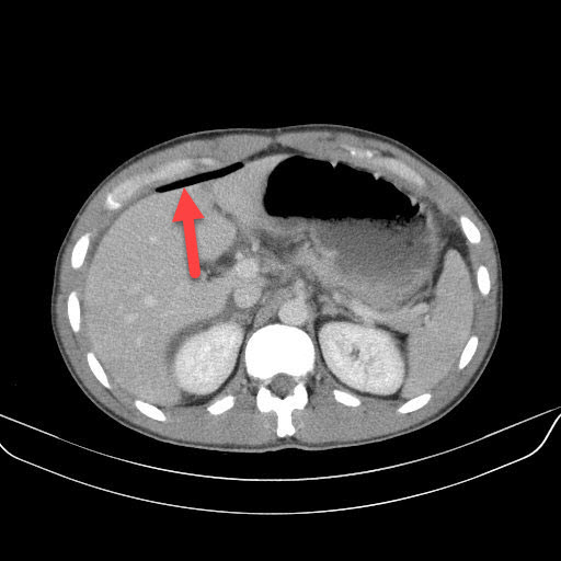 Pneumoperitoneum Radiology For Beginners by Dr. med. Samuel Kobba