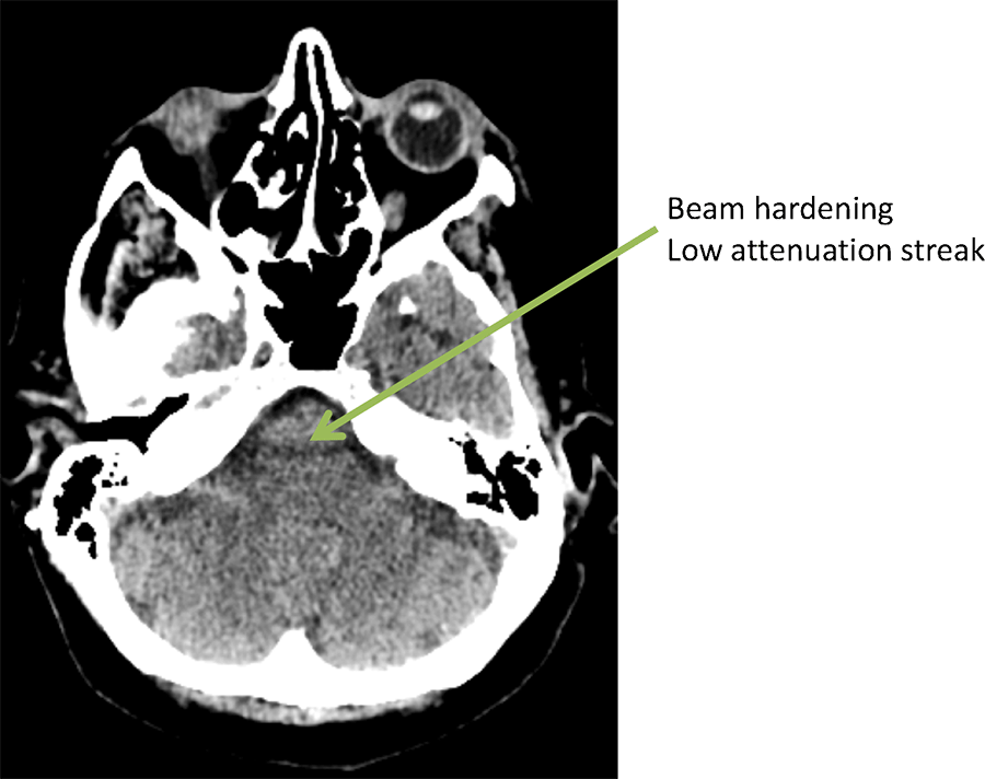 CT artefacts Radiology Cafe