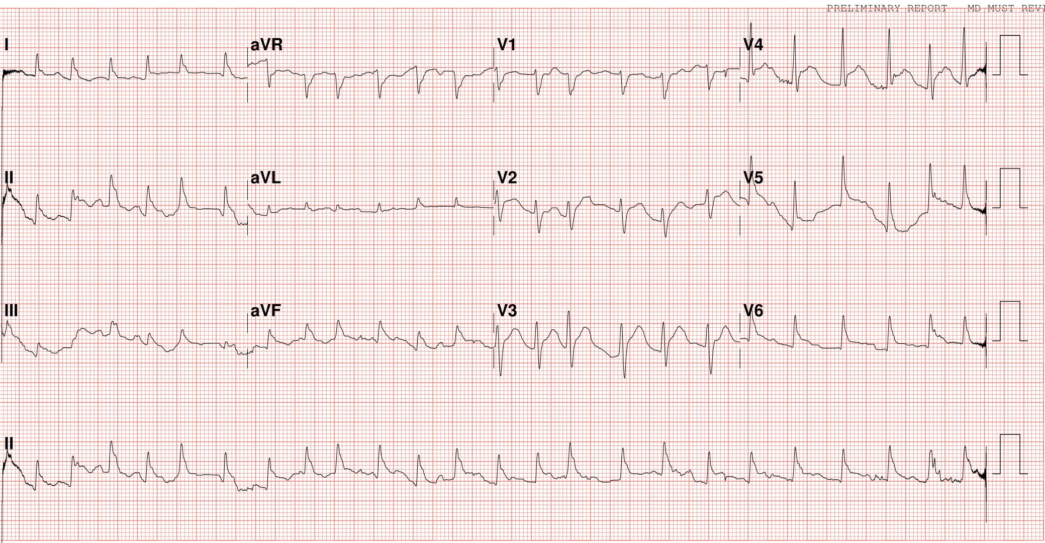 Case report of a submandibular abscess lethally tracking down through