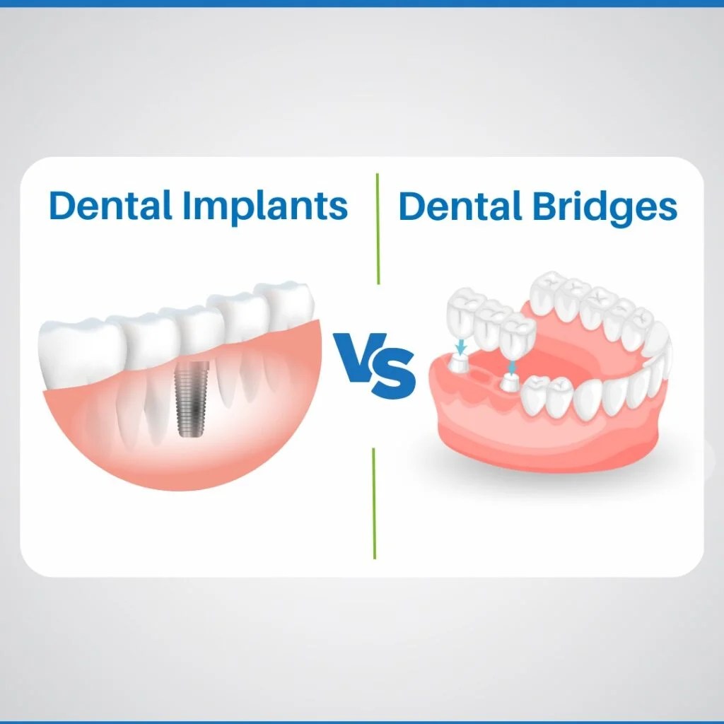 Dental Implant Vs. Bridge Pros, Cons, which is better