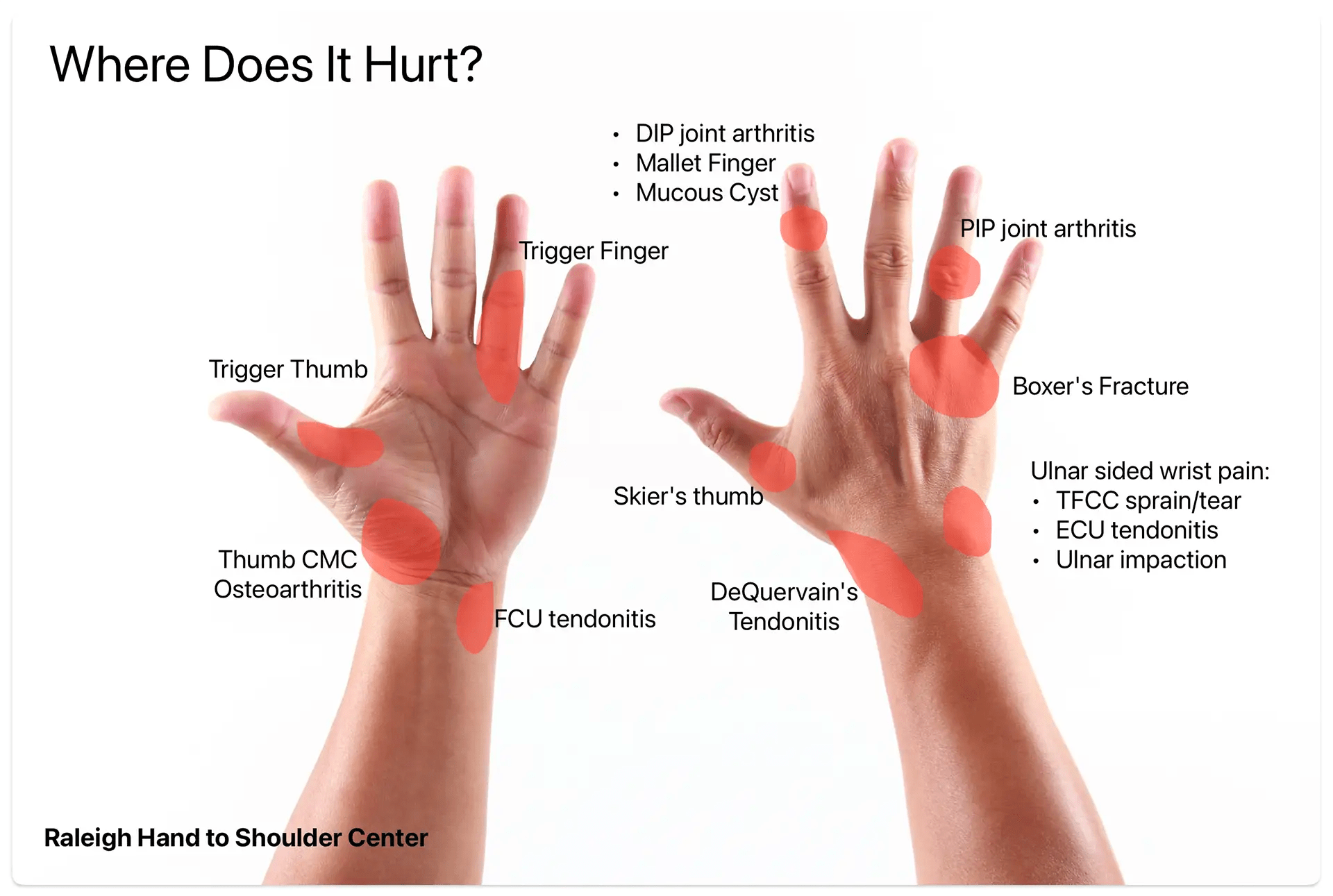 Tendons In Wrist Swollen