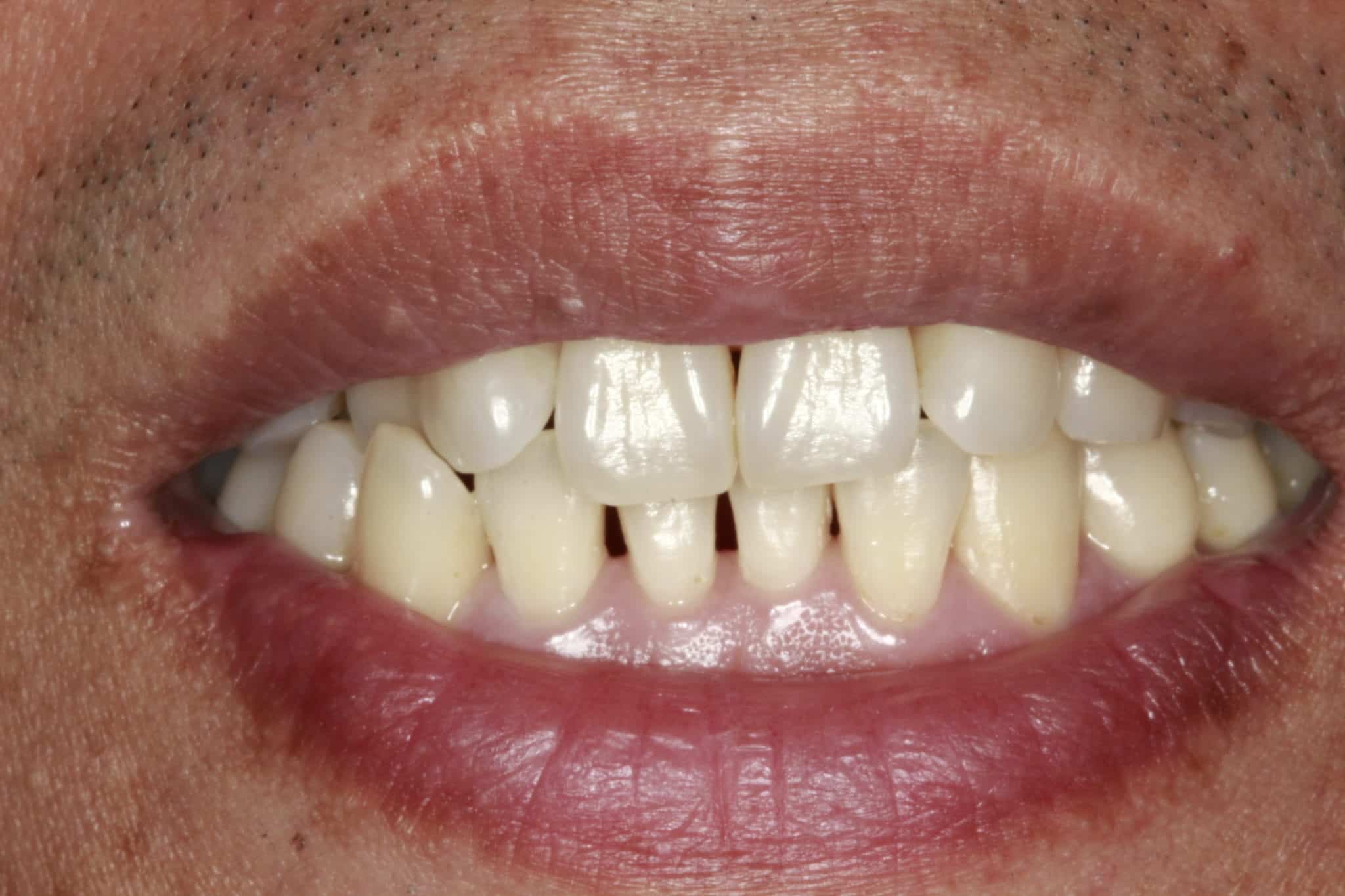 Bioclear Treatment in Santa Ana Dr. Randy Fong