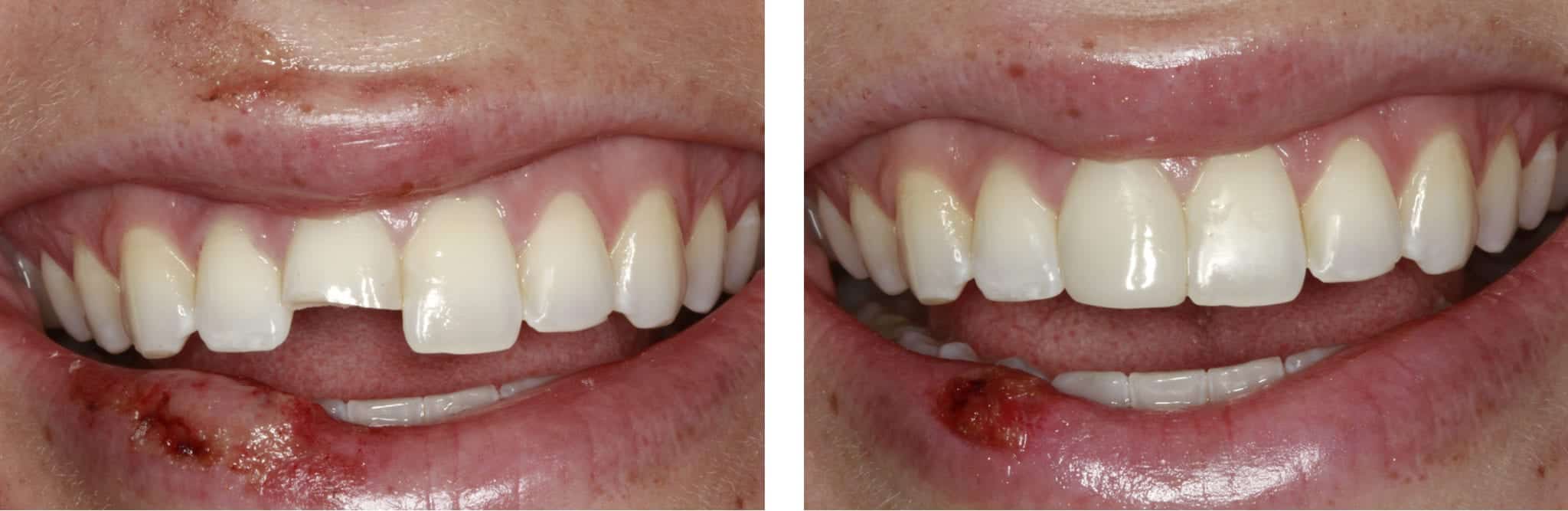 Teeth Treat Teeth whitening dentist los angeles