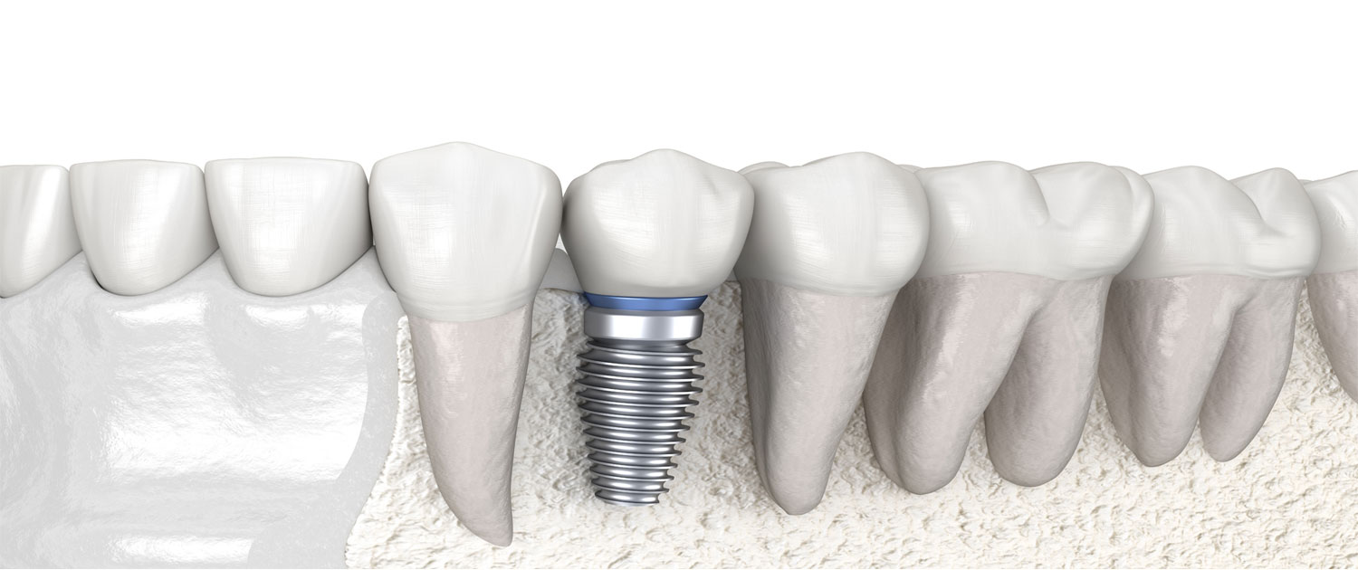 dentalimplants Rangewood Dental
