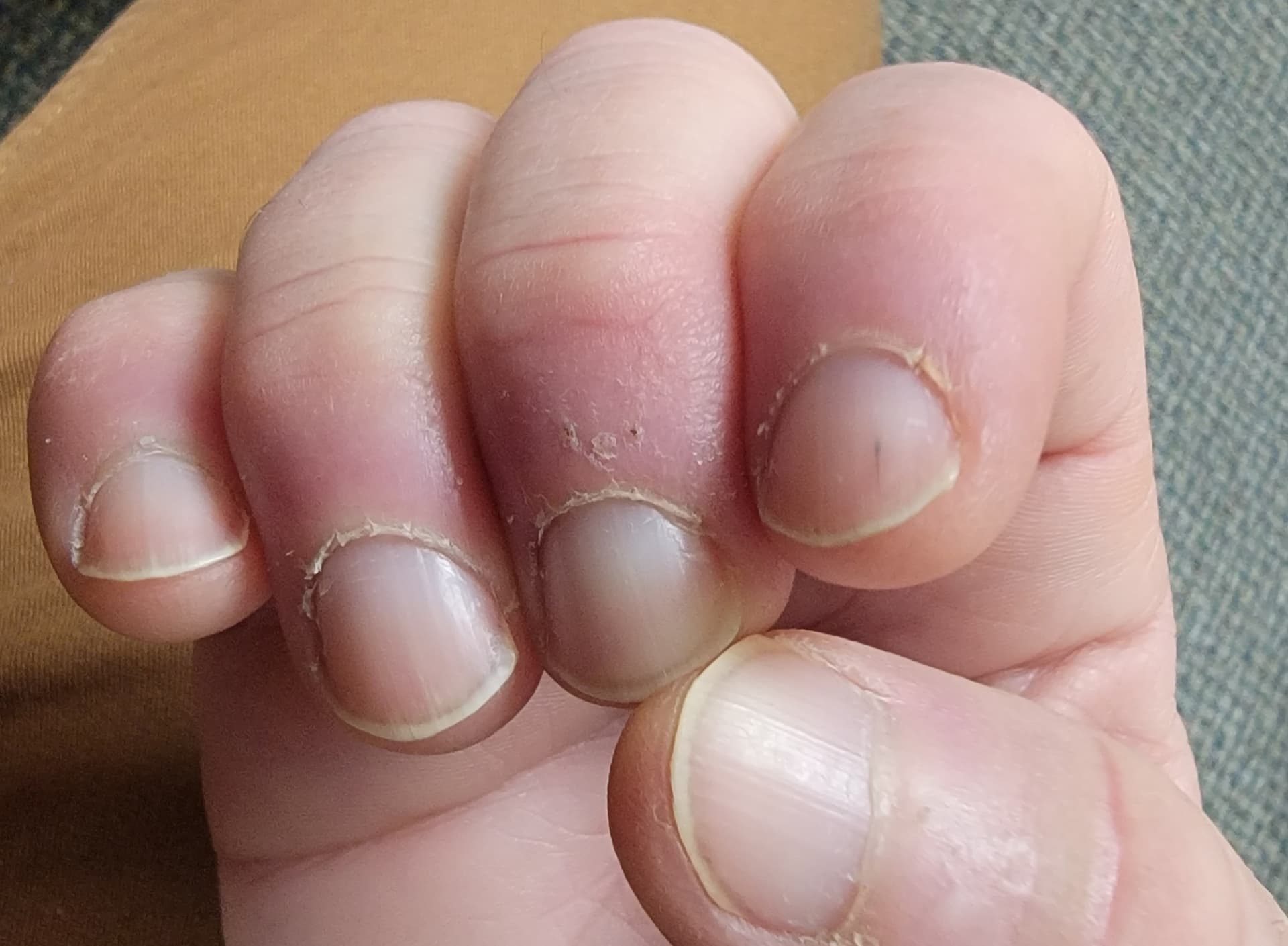 No Half Moons On Fingernails