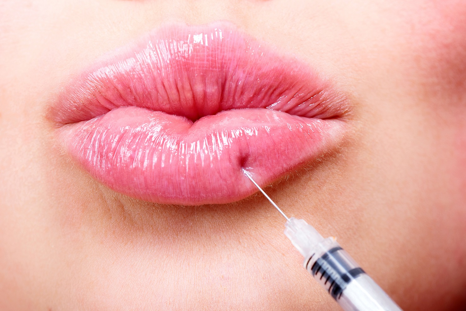 How Injectables Can Put Cupid’s Bow in Your Lip