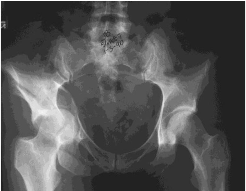 Pelvic Fractures A guide to treatment within a Trauma Unit