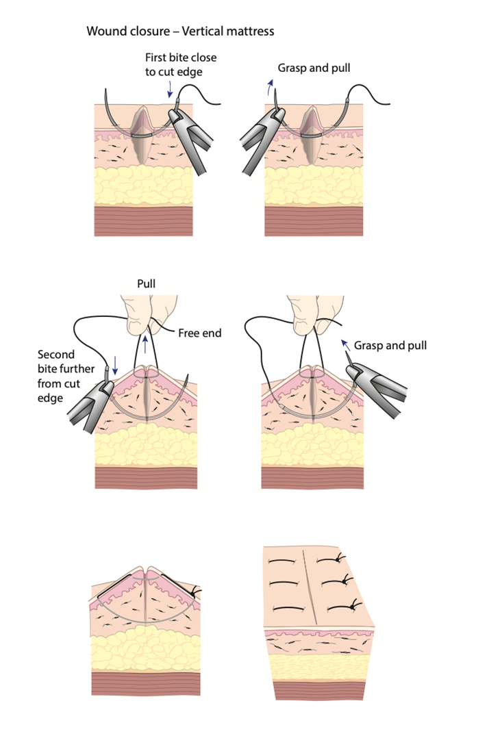 Surgical Management of Acute Wounds in the ED RCEMLearning