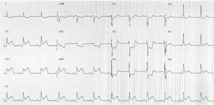 ST Elevation without Infarction RCEMLearning