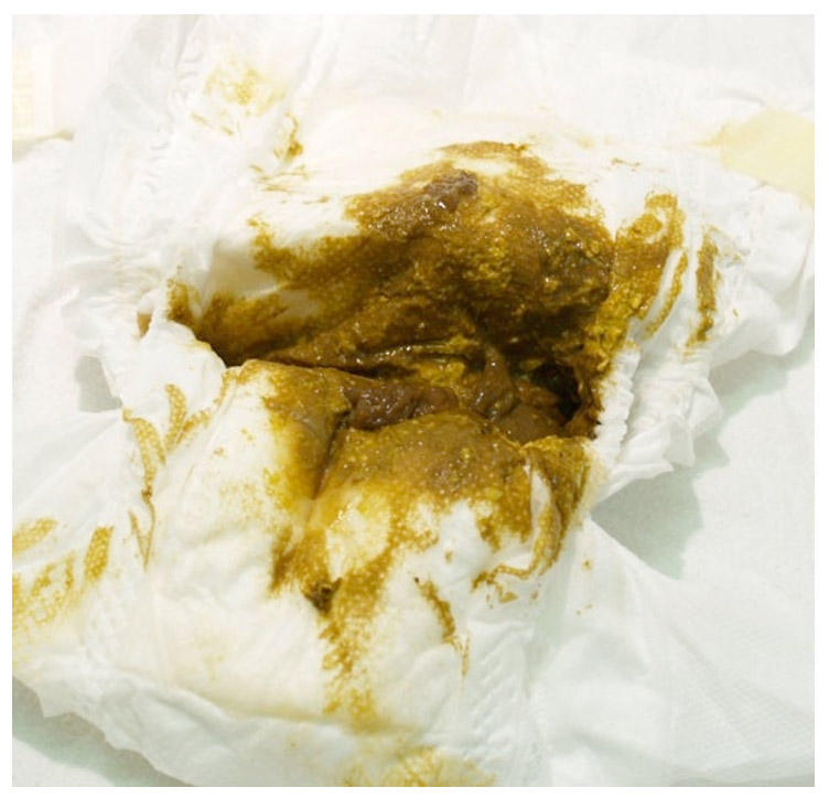 Neonatal Nuggets Part 2 tummy troubles RCEMLearning