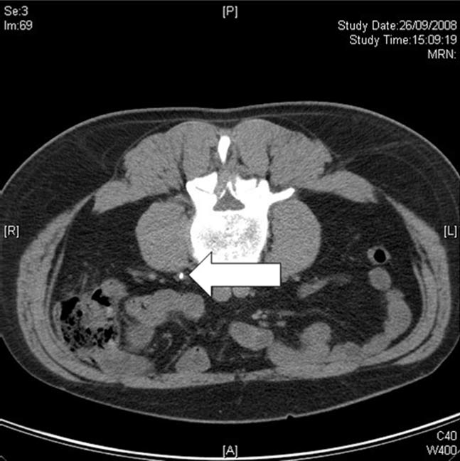 Renal Colic RCEMLearning