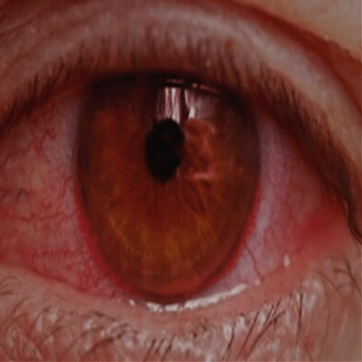 My Eye Feels Inflamed! RCEMLearning India